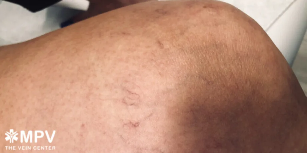 Spider veins on the leg