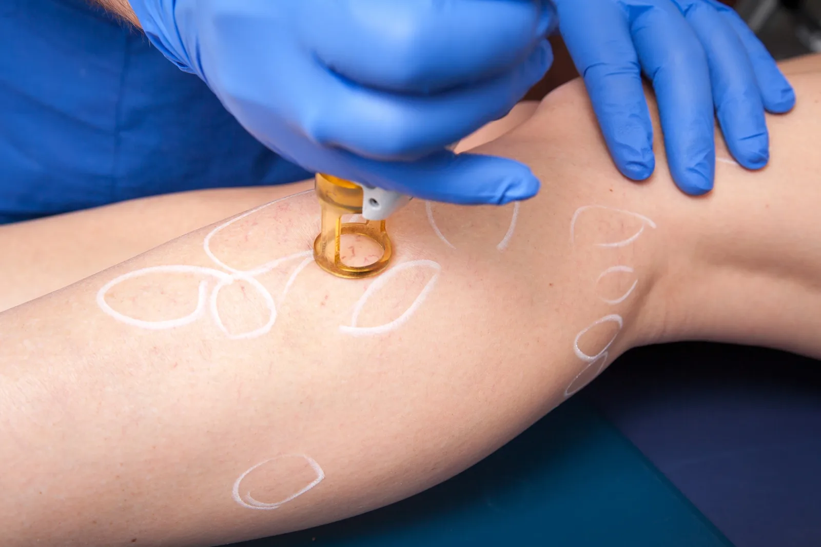 When Spider Veins are Very Fine: Causes, Symptoms, and